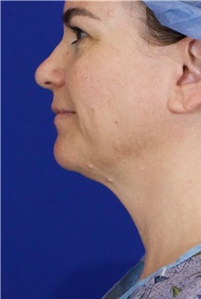 Facelift Before Photo by Thanapoom Boonipat, MD; Lubbock, TX - Case 51424