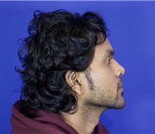 Chin Augmentation After Photo by Thanapoom Boonipat, MD; Lubbock, TX - Case 51426