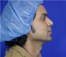 Chin Augmentation Before Photo by Thanapoom Boonipat, MD; Lubbock, TX - Case 51426