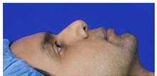 Chin Augmentation Before Photo by Thanapoom Boonipat, MD; Lubbock, TX - Case 51426