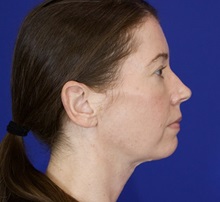 Facelift After Photo by Thanapoom Boonipat, MD; Lubbock, TX - Case 51433