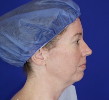 Facelift Before Photo by Thanapoom Boonipat, MD; Lubbock, TX - Case 51433