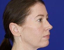 Facelift After Photo by Thanapoom Boonipat, MD; Lubbock, TX - Case 51433