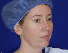 Facelift Before Photo by Thanapoom Boonipat, MD; Lubbock, TX - Case 51433