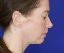 Facelift After Photo by Thanapoom Boonipat, MD; Lubbock, TX - Case 51433