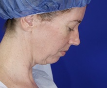 Facelift Before Photo by Thanapoom Boonipat, MD; Lubbock, TX - Case 51433