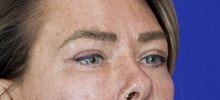 Eyelid Surgery After Photo by Thanapoom Boonipat, MD; Lubbock, TX - Case 51432