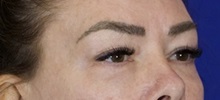 Eyelid Surgery Before Photo by Thanapoom Boonipat, MD; Lubbock, TX - Case 51432