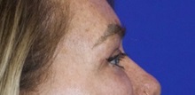 Eyelid Surgery After Photo by Thanapoom Boonipat, MD; Lubbock, TX - Case 51432