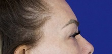 Eyelid Surgery Before Photo by Thanapoom Boonipat, MD; Lubbock, TX - Case 51432