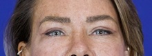 Eyelid Surgery After Photo by Thanapoom Boonipat, MD; Lubbock, TX - Case 51432
