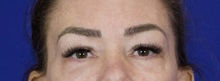 Eyelid Surgery Before Photo by Thanapoom Boonipat, MD; Lubbock, TX - Case 51432