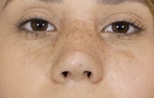 Rhinoplasty After Photo by Thanapoom Boonipat, MD; Lubbock, TX - Case 51437