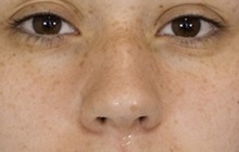 Rhinoplasty Before Photo by Thanapoom Boonipat, MD; Lubbock, TX - Case 51437