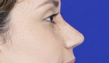 Rhinoplasty After Photo by Thanapoom Boonipat, MD; Lubbock, TX - Case 51437