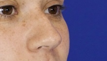 Rhinoplasty Before Photo by Thanapoom Boonipat, MD; Lubbock, TX - Case 51437