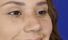 Rhinoplasty After Photo by Thanapoom Boonipat, MD; Lubbock, TX - Case 51437