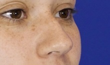 Rhinoplasty Before Photo by Thanapoom Boonipat, MD; Lubbock, TX - Case 51437