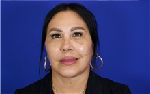 Facelift After Photo by Thanapoom Boonipat, MD; Lubbock, TX - Case 51427
