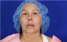 Facelift Before Photo by Thanapoom Boonipat, MD; Lubbock, TX - Case 51427
