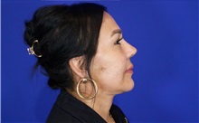 Facelift After Photo by Thanapoom Boonipat, MD; Lubbock, TX - Case 51427