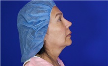 Facelift Before Photo by Thanapoom Boonipat, MD; Lubbock, TX - Case 51427
