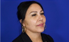 Facelift After Photo by Thanapoom Boonipat, MD; Lubbock, TX - Case 51427