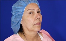 Facelift Before Photo by Thanapoom Boonipat, MD; Lubbock, TX - Case 51427