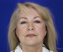 Facelift After Photo by Thanapoom Boonipat, MD; Lubbock, TX - Case 51428
