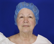 Facelift Before Photo by Thanapoom Boonipat, MD; Lubbock, TX - Case 51428