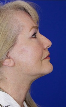 Facelift After Photo by Thanapoom Boonipat, MD; Lubbock, TX - Case 51428