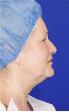 Facelift Before Photo by Thanapoom Boonipat, MD; Lubbock, TX - Case 51428