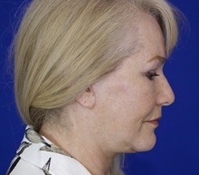 Facelift After Photo by Thanapoom Boonipat, MD; Lubbock, TX - Case 51428