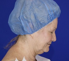 Facelift Before Photo by Thanapoom Boonipat, MD; Lubbock, TX - Case 51428