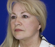 Facelift After Photo by Thanapoom Boonipat, MD; Lubbock, TX - Case 51428