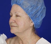 Facelift Before Photo by Thanapoom Boonipat, MD; Lubbock, TX - Case 51428