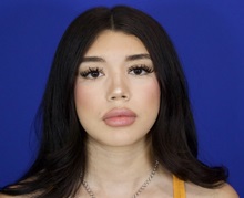 Rhinoplasty After Photo by Thanapoom Boonipat, MD; Lubbock, TX - Case 51429