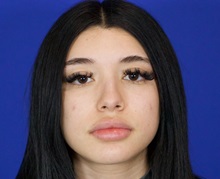 Rhinoplasty Before Photo by Thanapoom Boonipat, MD; Lubbock, TX - Case 51429