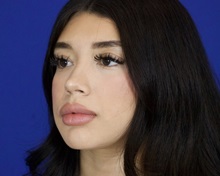 Rhinoplasty After Photo by Thanapoom Boonipat, MD; Lubbock, TX - Case 51429