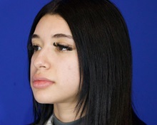 Rhinoplasty Before Photo by Thanapoom Boonipat, MD; Lubbock, TX - Case 51429