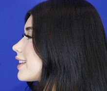 Rhinoplasty After Photo by Thanapoom Boonipat, MD; Lubbock, TX - Case 51429