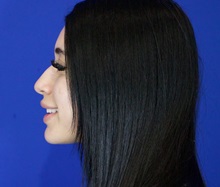 Rhinoplasty Before Photo by Thanapoom Boonipat, MD; Lubbock, TX - Case 51429