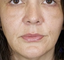 Rhinoplasty After Photo by Thanapoom Boonipat, MD; Lubbock, TX - Case 51436