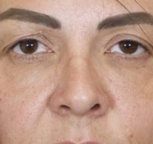 Rhinoplasty Before Photo by Thanapoom Boonipat, MD; Lubbock, TX - Case 51436
