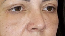 Rhinoplasty After Photo by Thanapoom Boonipat, MD; Lubbock, TX - Case 51436