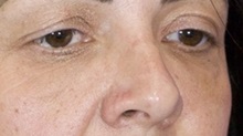 Rhinoplasty Before Photo by Thanapoom Boonipat, MD; Lubbock, TX - Case 51436