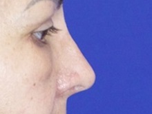 Rhinoplasty After Photo by Thanapoom Boonipat, MD; Lubbock, TX - Case 51436