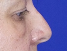 Rhinoplasty Before Photo by Thanapoom Boonipat, MD; Lubbock, TX - Case 51436