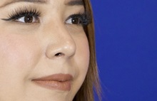 Rhinoplasty After Photo by Thanapoom Boonipat, MD; Lubbock, TX - Case 51434