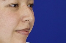 Rhinoplasty Before Photo by Thanapoom Boonipat, MD; Lubbock, TX - Case 51434